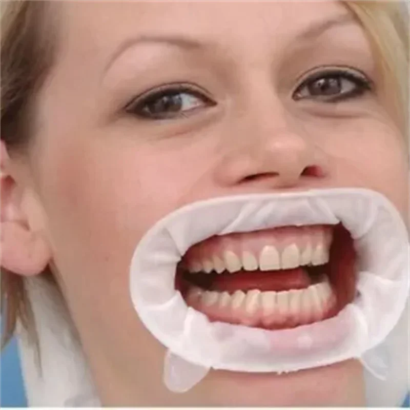 치과용 입개척기 오프트라 게이트 3D 입술 개방기 일회 - 3D Printing Orthodontics 리뷰 및 가격